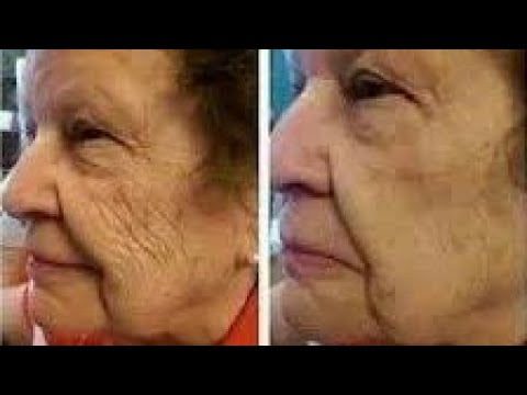Elimina Rugas? Sebo de Carneiro para Rugas como Usar