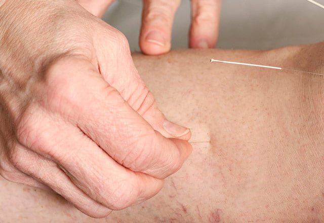 Acupuntura Parkinson - Como Melhorar Os Sintomas Do Mal De Parkinson (Doença De Parkinson)