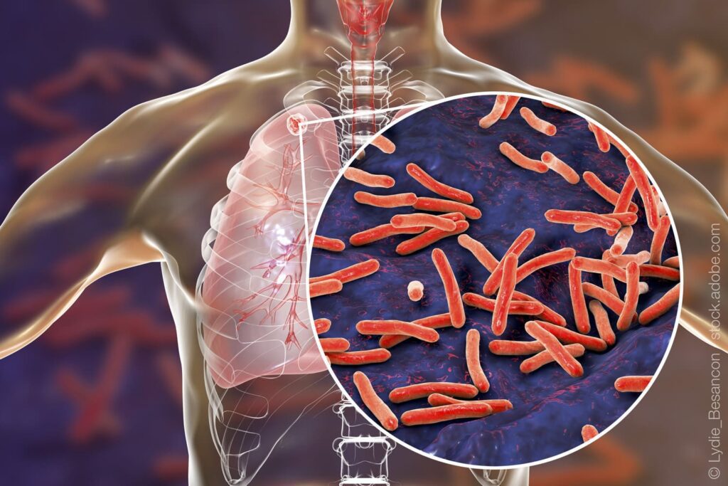 Como Diagnosticar a Tuberculose?