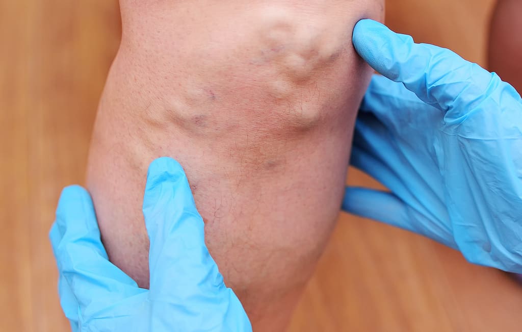 Diagnosticando Trombose Venosa Profunda e Embolia Pulmonar